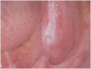 義歯性口内炎1