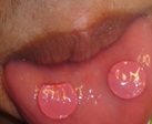 口内炎 パッチ 舌 歯茎 唇2