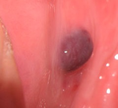 口の中 舌に出来た血豆の原因 治し方 治療法 癌や病気の可能性 口内炎の治し方決定版 正しい原因と治療の3原則