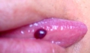舌 血豆