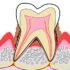 歯周病 口内炎 口臭